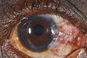 neoplasia squamous ossn ocular gichuhi