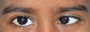 PHFI CEHJ » Common eye diseases in school going children