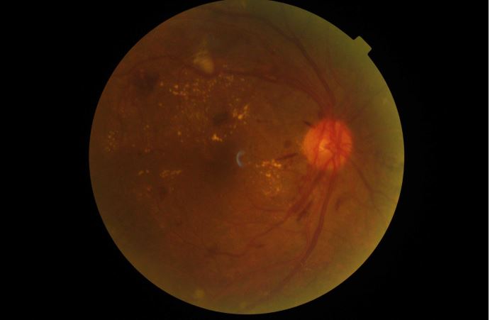 Severe non proliferative diabetic retinopathy with clinically significant macular edema in right eye. © Tilganga Institute of Ophthalmology. Nepal