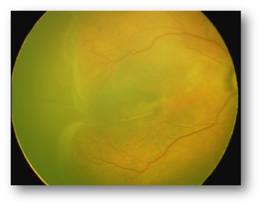 Figure 1A RetCamShuttle (Natus USA) image of Stage 3 ROP in the right eye. The image is rectangular due to the 1800 x 1600 sensor of the camera. (c)KIDROP Programme