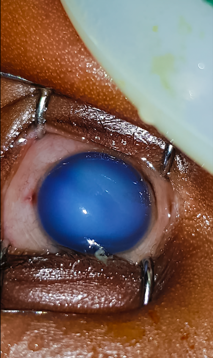 Chlorhexidine 7.1% is toxic to the cornea. KENYA © Michael Gichangi