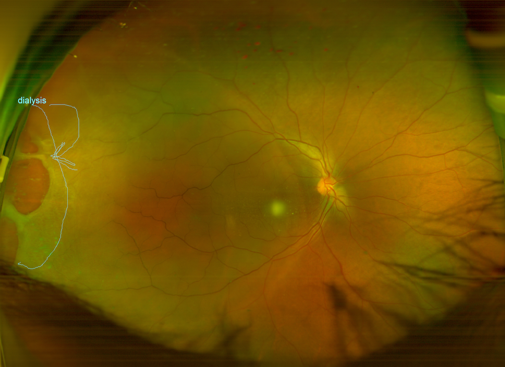 Figure 1 Retinal dialysis imaged with an ultra-wide field camera. INDIA © Manoj Sasawde