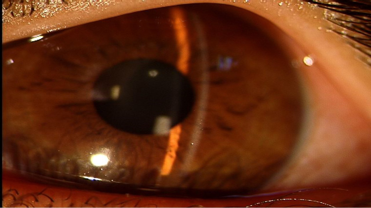 Shallow anterior chamber seen with a torchlight. INDIA © Madhu Bhadauria