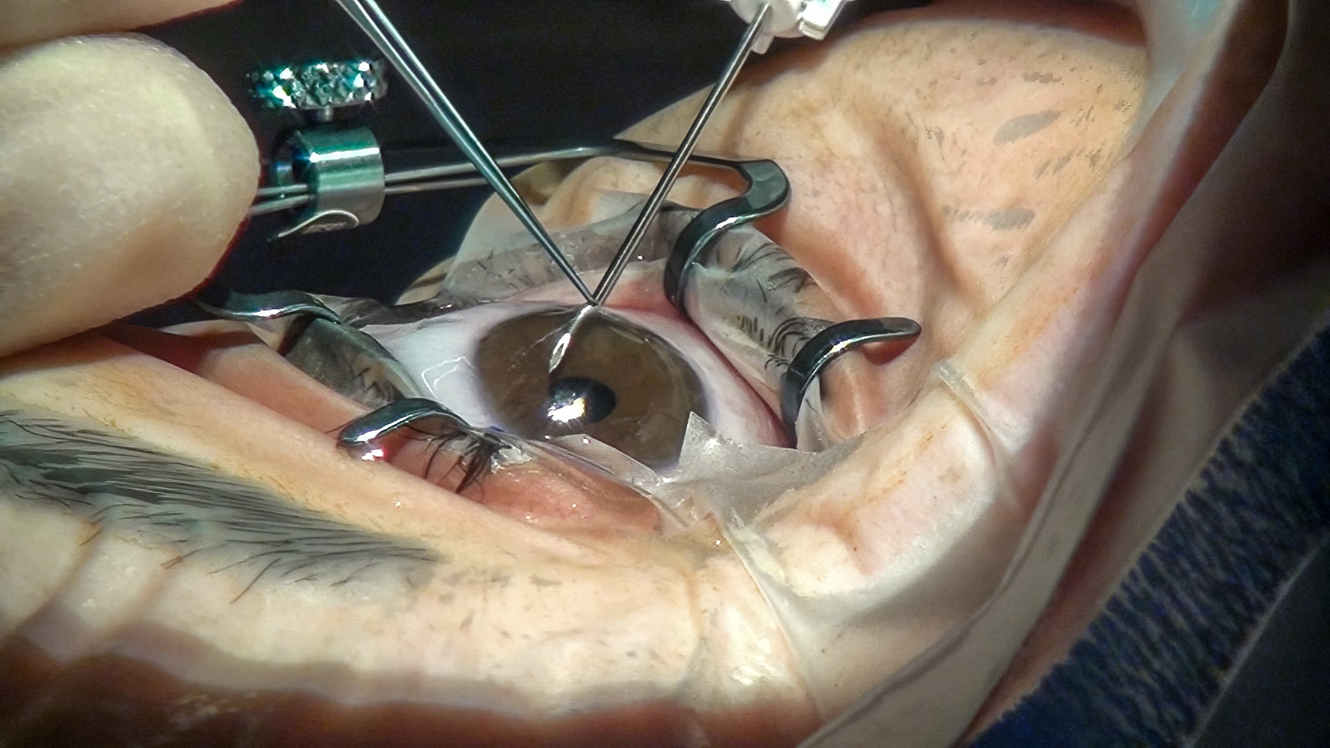 Figure 1: A minimally invasive glaucoma surgery device is implanted through the anterior chamber. Photo Credit: © Keith Barton CC BY-NC 4.0