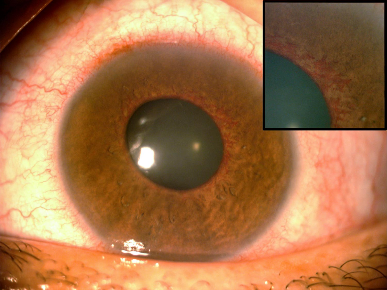 Figure 1: A diabetic patient that presented with severe pain, blurred vision and red eye. Signs of the acute stage of neovascular glaucoma are seen in this photo: ciliary injection, mild corneal epithelial oedema, and rubeosis iridis. Top right: An enlarged view of rubeosis iridis. Photo Credit: © University Hospital and Faculty of Medicine, Autonomous University of Nuevo Leon (UANL), Mexico CC BY-NC 4.0