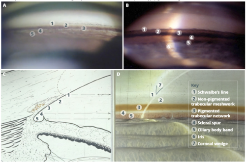 Figure 1: Two photographs (A and B) and two drawings (C and D) showing the structures seen on gonioscopy of an open angle. B shows a patient with pigment dispersion where the angle is densely pigmented, especially the pigmented trabecular meshwork. Some patients may have very little pigment present (hypopigmented angle) and identifying the different structures can be challenging. The bottom left image shows a cross-section of the corresponding image on the bottom right. The corneal wedge is shown where the reflections from the inner and outer aspects of the cornea meet, showing the position of Schwalbe’s line, helpful in hypopigmented angles. Photo Credit:© Professor Alward and University of Iowa Health Care (www.gonioscopy.org) CC BY-NC 4.0