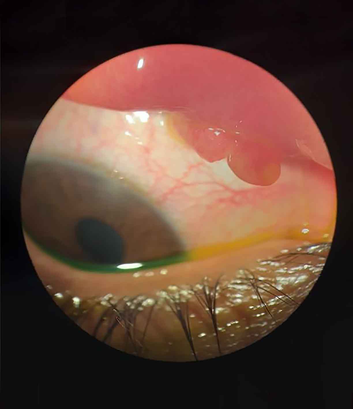 Figure 1 Pedunculated vascular fleshy growth (arrow) on palpebral conjunctiva of upper eyelid (right eye). Photo CreditL LVPEI