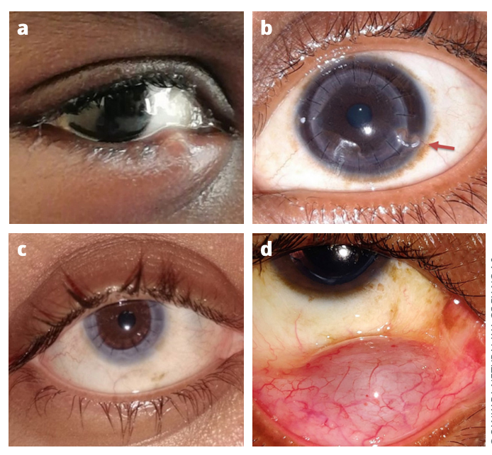 Figure 1 Photographs patients have taken of their own eyes after watching a video on how to take good quality photographs. a Hordeolum externum (stye). b Loose sutures following corneal graft. c Follow-up photo of deep anterior lamellar keratoplasty (DALK). d Conjunctival cyst. Photo Credit: Sankara Nethralaya