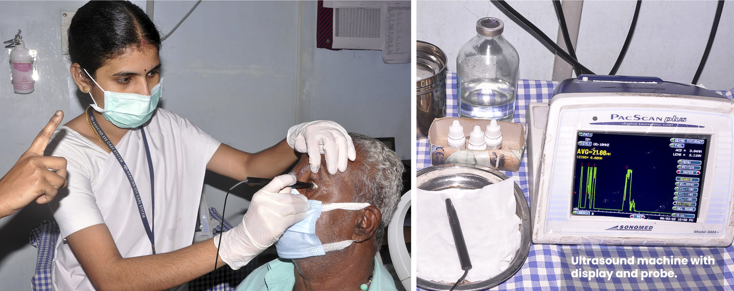 Figure 1: A biometrist performs contact (applanation) ultrasound biometry, India. (Photo: MOHAN RAJA CC BY-NC 4.0)