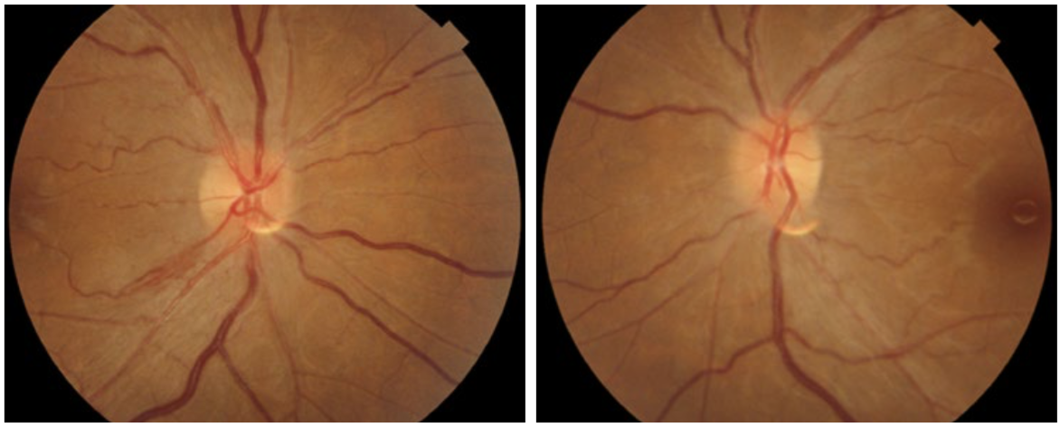 Figure 1 Bilateral toxic optic neuropathy with disc oedema in a 32-year-old female patient with a history of ethambutol intake and on tacrolimus after a renal transplant (Photo: SHAILJA TIBREWAL, SCEH CC BY-NC-SA 4.0)