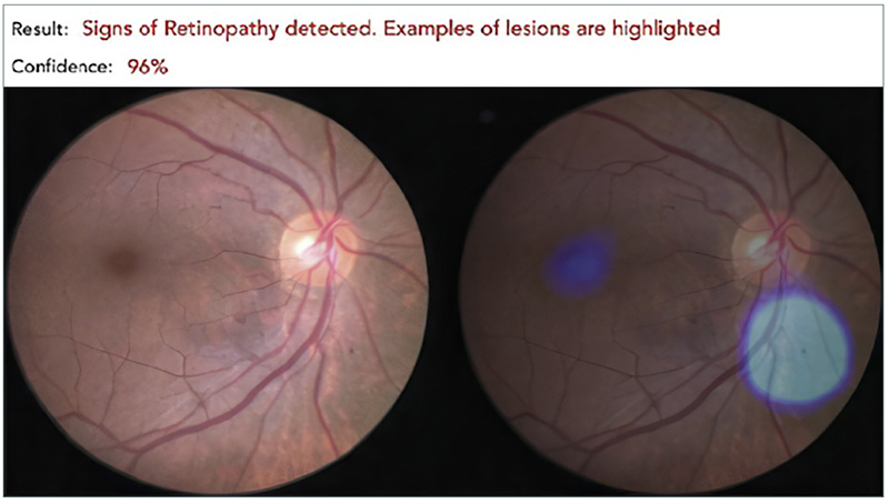 An example of the output from an AI algorithm, showing the image and a diagnosis of diabetic retinopathy (ungraded). (Photos: Medios CC BY-NC-SA 4.0)