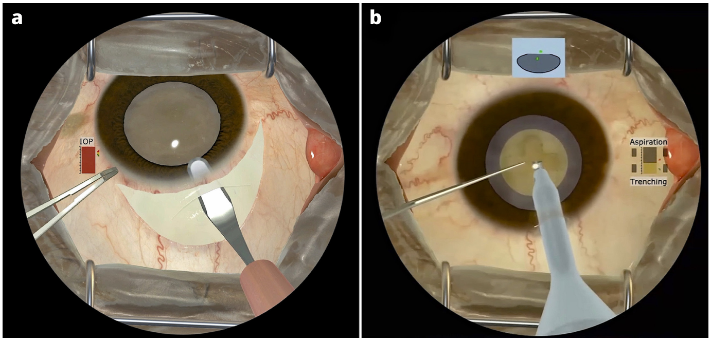 PHFI CEHJ » More than simulation the HelpMeSee approach to cataract